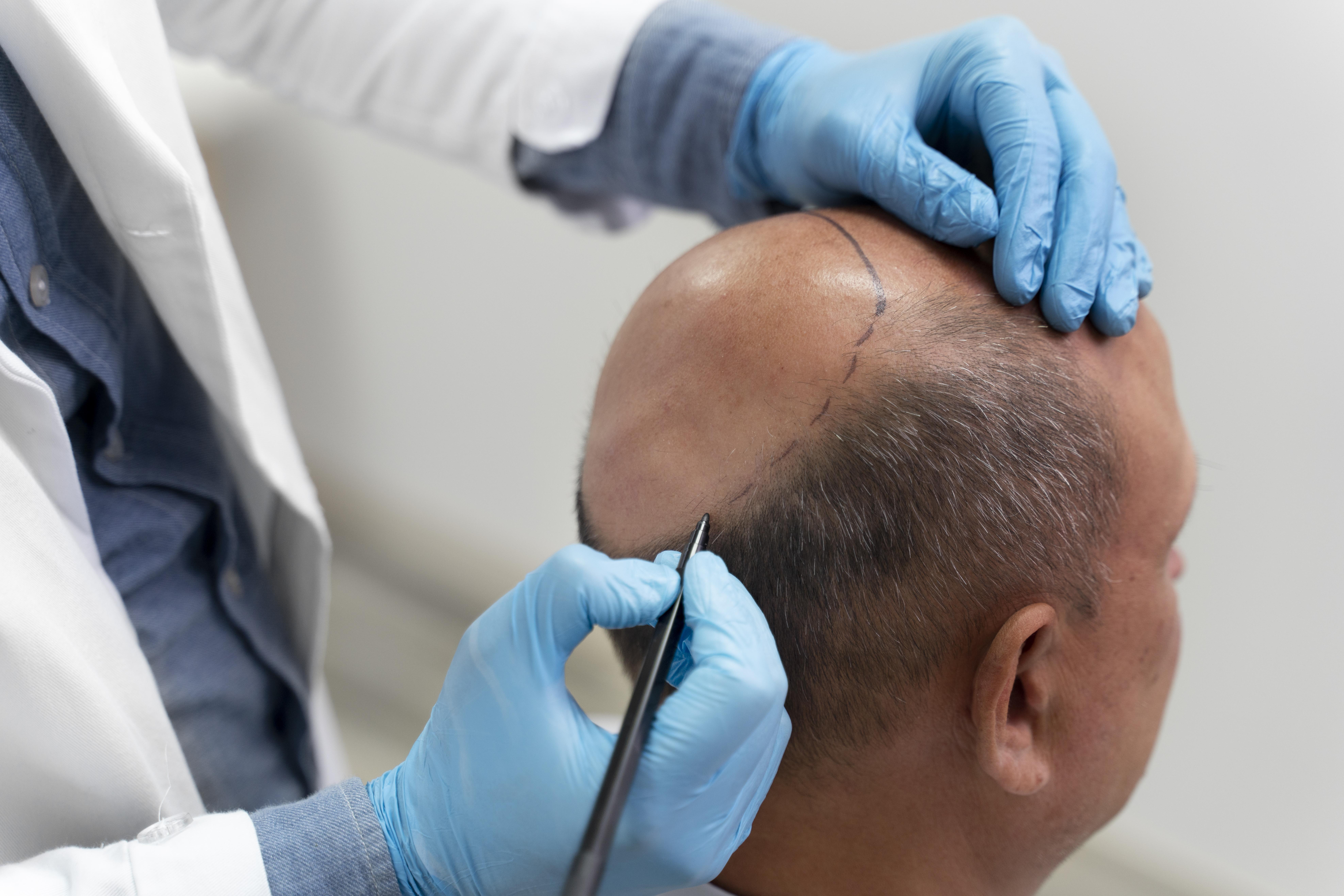 a man preparing to undergo hair transplant