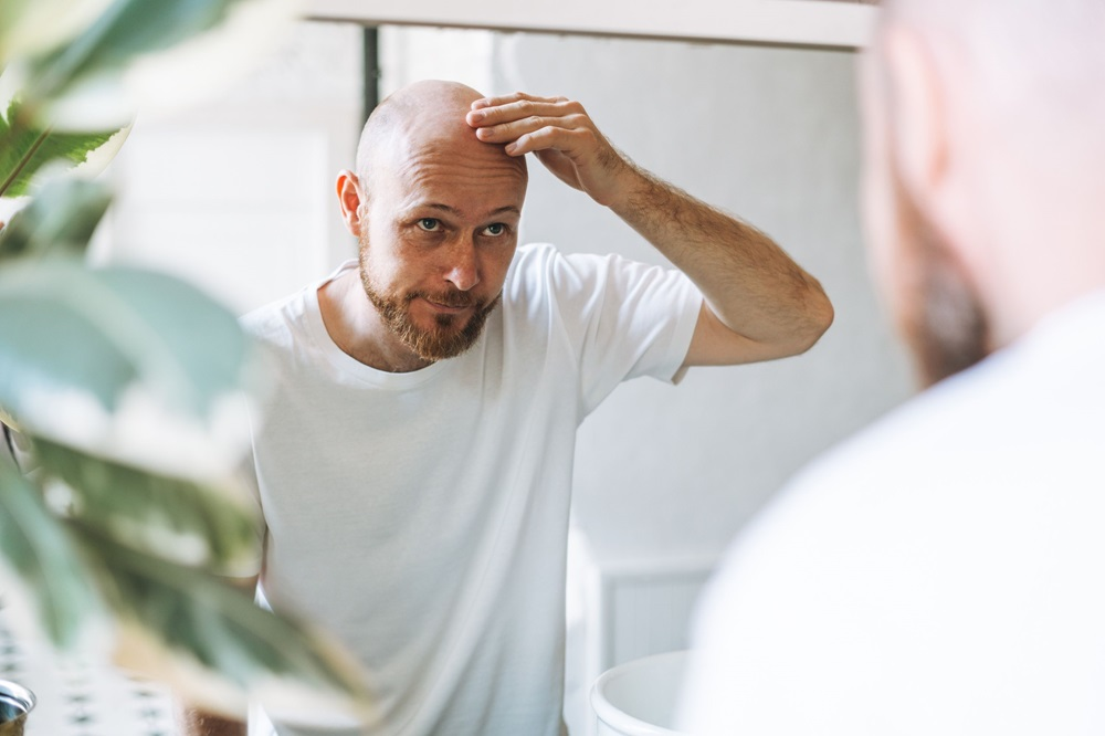 A man with a bald spot on his head, showing the effects of traction alopecia