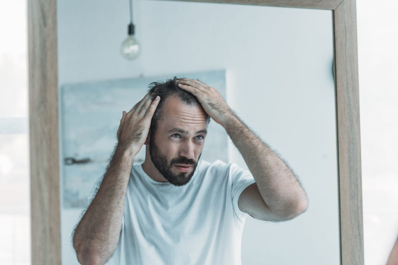 A man showing symptoms of hair loss