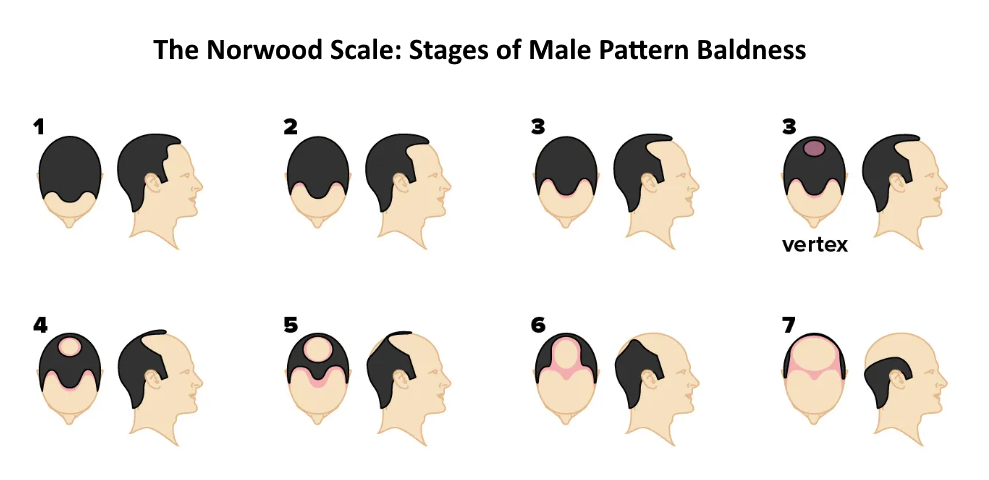 Norwood Scale of Male Pattern Baldness