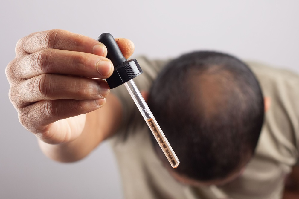 man with thinning hair ready to apply minoxidil directly to scalp using medicine dropper