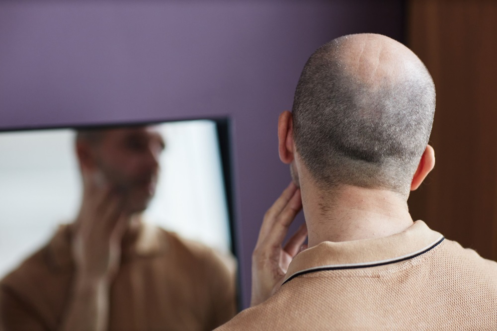 A man wearing a hat and looking in the mirror, showing his receding hairline